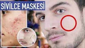 Sivilceli ve Akneli Ciltler İçin Maske