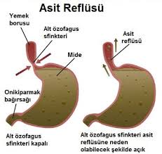 Asit Reflü Nedir