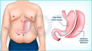 Tup Mide Mide Kucultme Ameliyati Nedir 1024x575