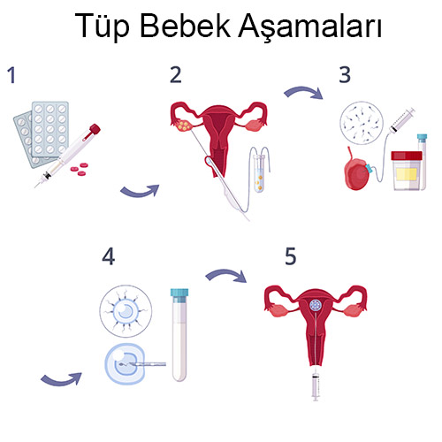 tüp bebek